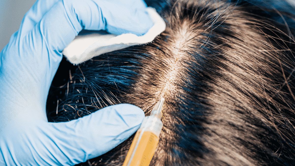 Greffe de cheveux : les avantages et les inconvénients, Avant Après