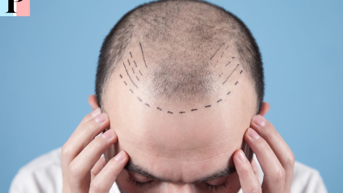 Greffe de cheveux : le meilleur moyen de plaire au femme et de retrouver votre virilité
