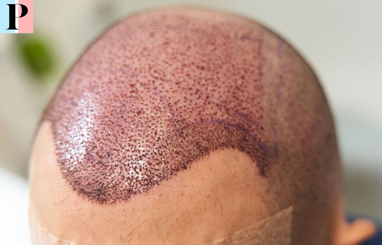 Türkiye para el trasplante de cabello