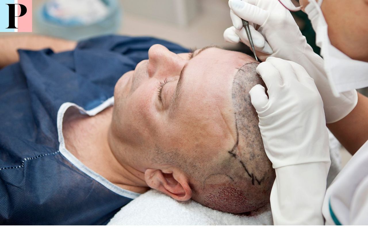 Türkiye para implantes capilares