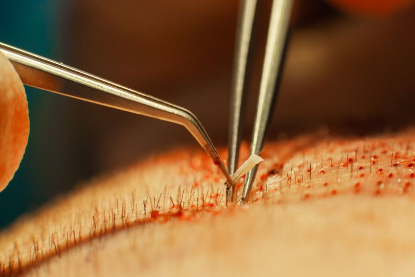 Are there medical treatments and natural remedies for baldness?  