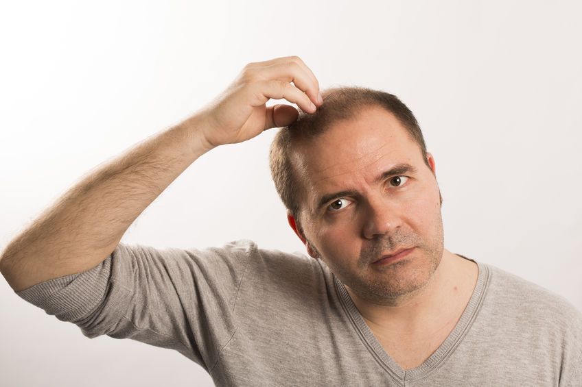 Baldness: what are the different causes?  